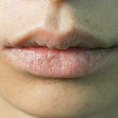4 common mistakes that make one’s lips dry and damaged